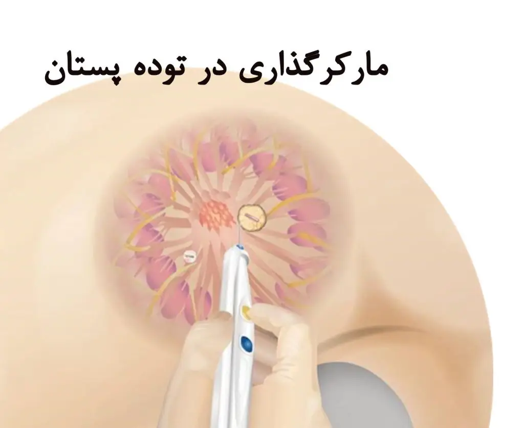 مارکرگذاری(کلیپس گذاری) در توده های پستان کلینیک تصویربرداری صبا دکتر سپیده سفیدبخت